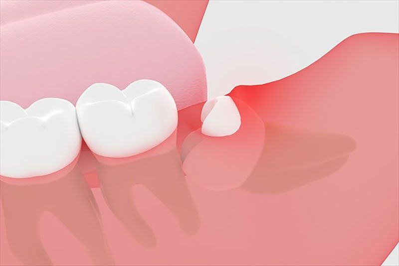 3．親知らずが倒れている場合など、抜歯に手術が必要な「難抜歯」の場合の注意点は？