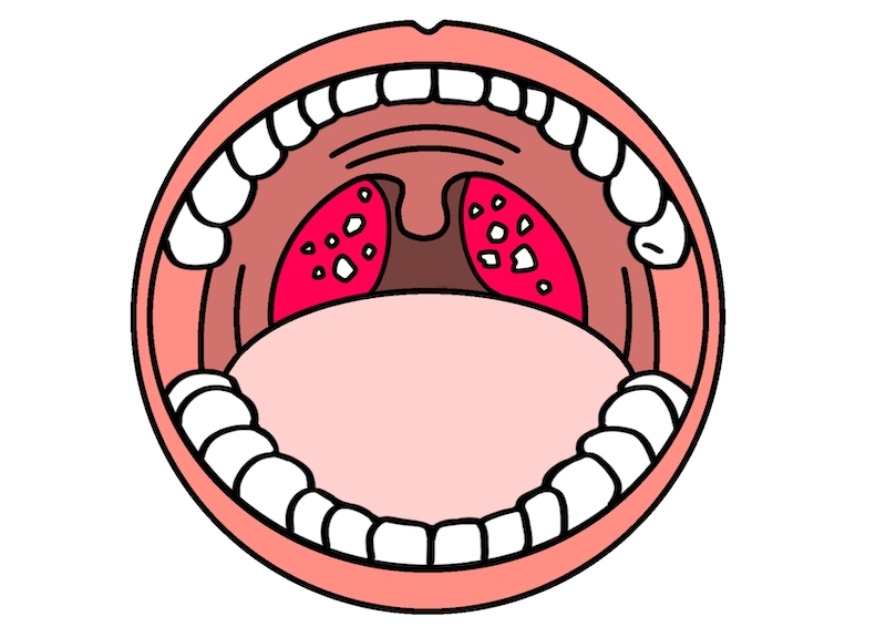 口臭のもと、臭い玉（膿栓）ができる原因は？どうやって取るの？