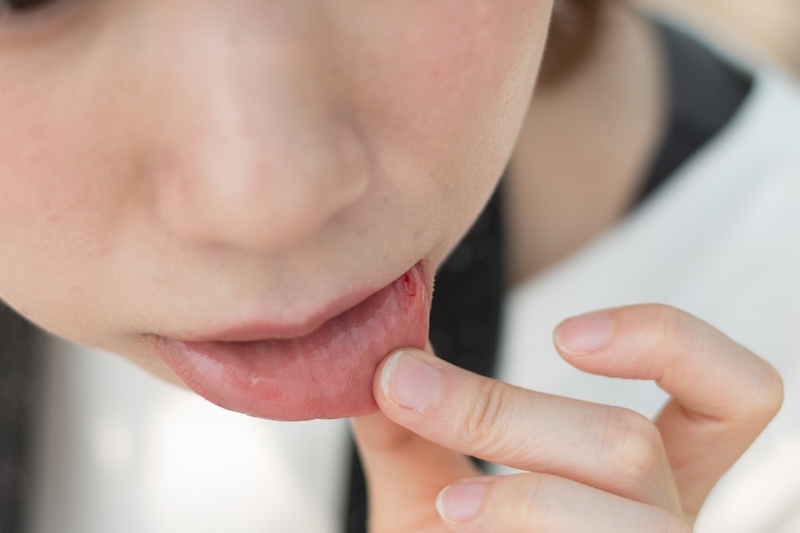 舌にできる口内炎の原因と治し方３つのポイント