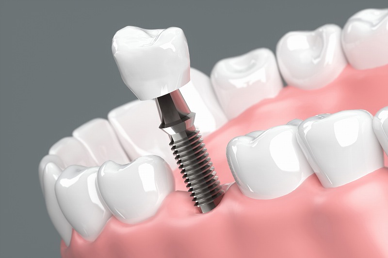 3.歯を失った場合の治療法