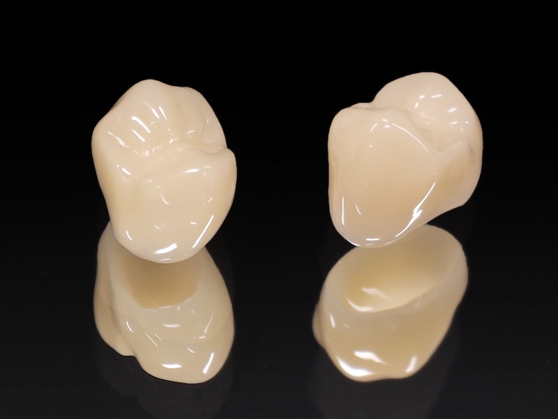 4.「CAD/CAM冠」と自費の白い歯との違いは？