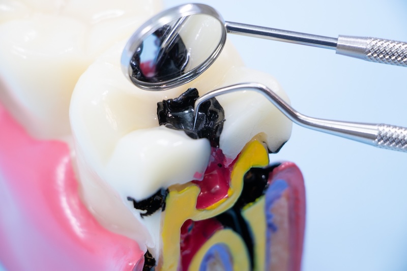 2.むし歯ができる原因