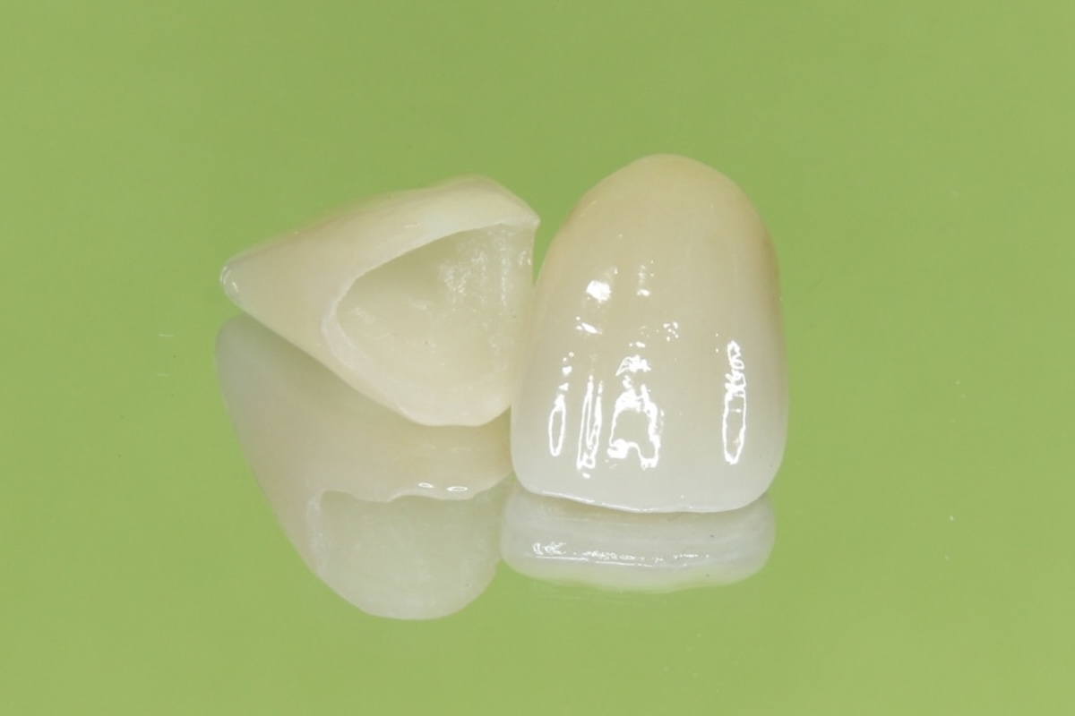 4.むし歯の再発を起こりにくくするには?~セラミックという選択~