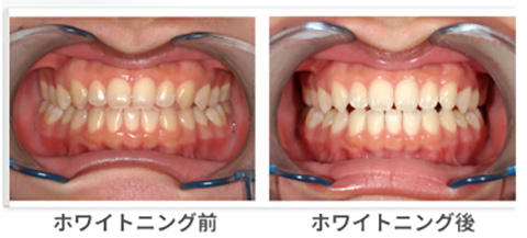 術前術後のビフォーアフター