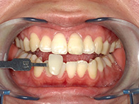 ホワイトニング