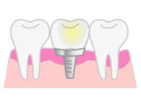 インプラント
