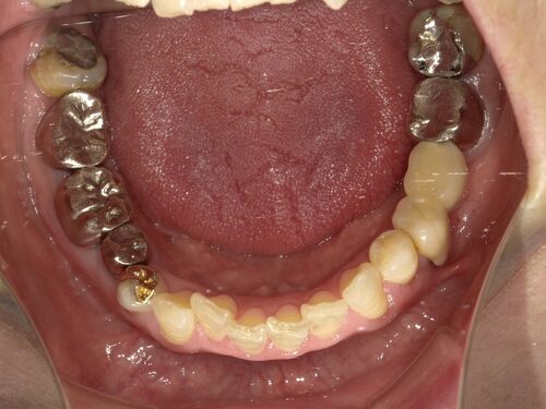 福山市のインプラント症例｜左上と右下の奥歯が割れて痛い状態にGBR・APFを行った術前写真