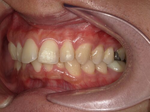 福山市の右上15インプラント症例｜1回法インプラント・ソケットリフト・CGFを併用した術後写真
