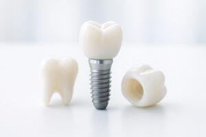 一生モノじゃないの？ インプラントの実際の寿命と、寿命を延ばす秘訣とは