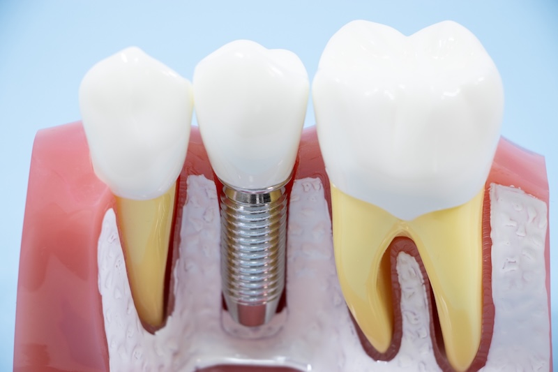 2.インプラントのメリット・デメリット
